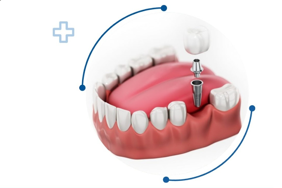 Lợi ích của trồng răng giả Implant