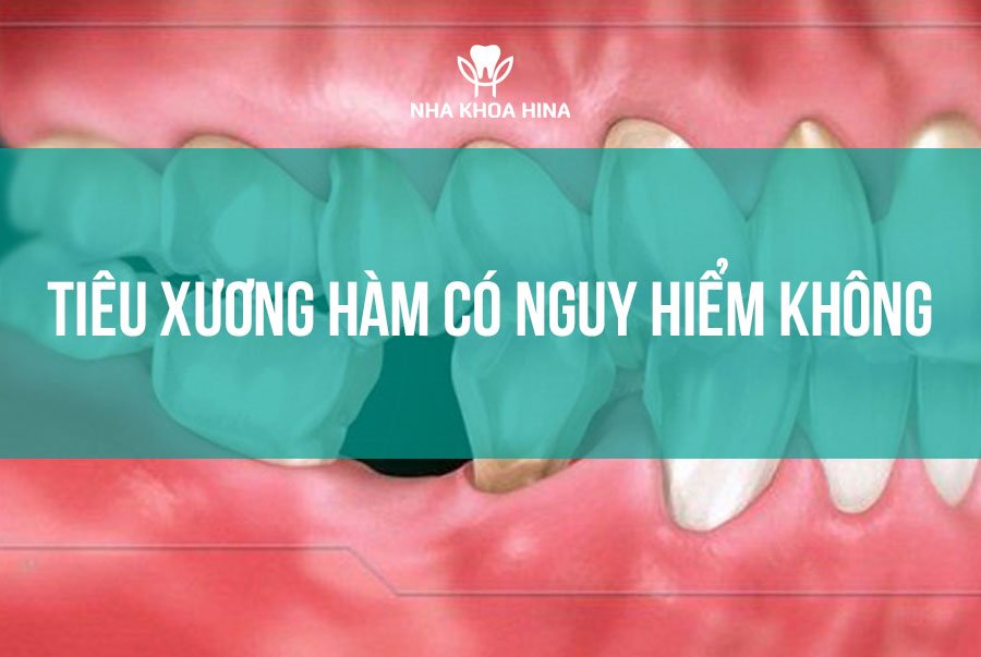 Tiêu xương hàm có nguy hiểm không?