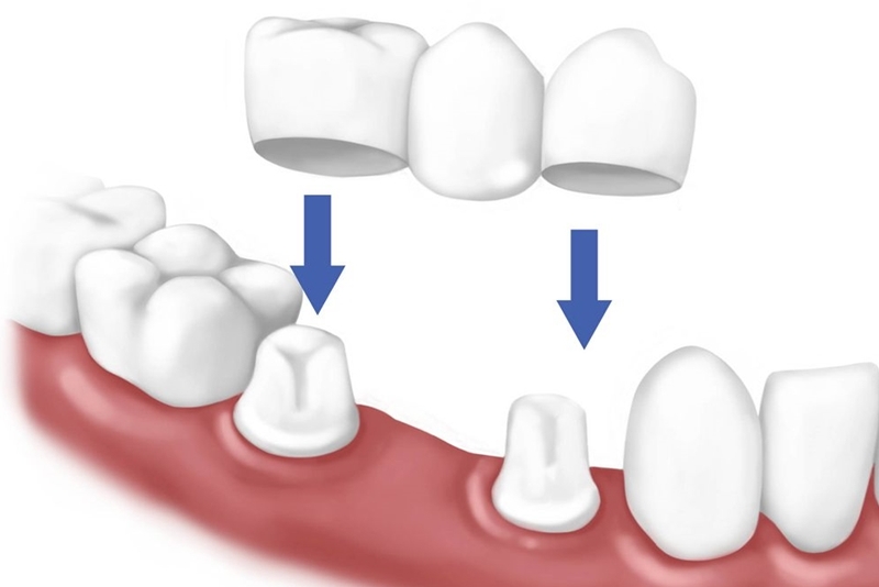 Chế Tác Cầu Răng Giả