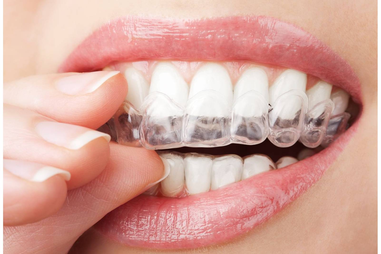 Niềng răng trong suốt (Invisalign)