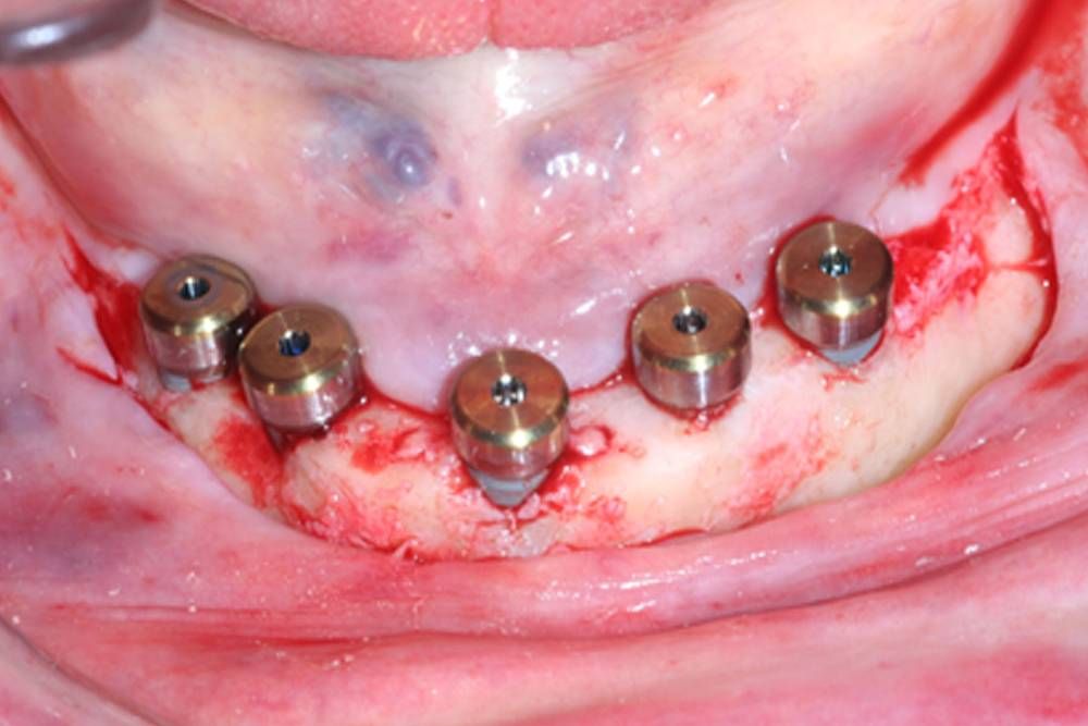 Healing Abutment được đặt sau cấy implant.