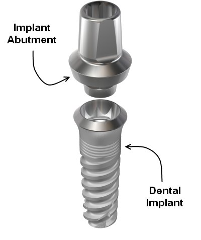 Abutment Implant kết nối răng sứ với trụ implant