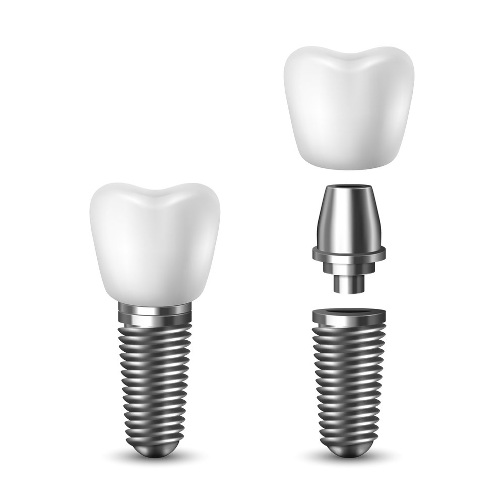 Răng sứ được kết nối với implant qua Abutment