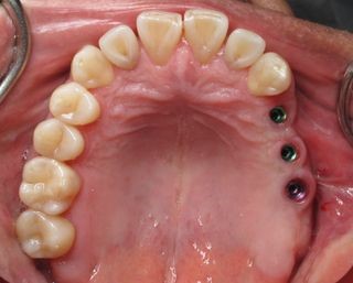 Bệnh nhân mất răng toàn hàm hàm trên được phục hồi lại bằng Implant