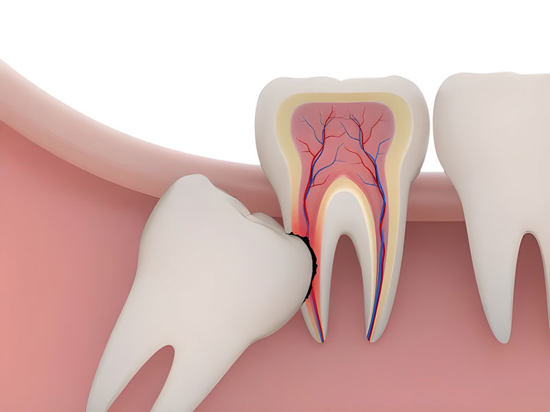 Mất ngủ vì đau răng khôn? Giải pháp hiệu quả tại Nha khoa Hina