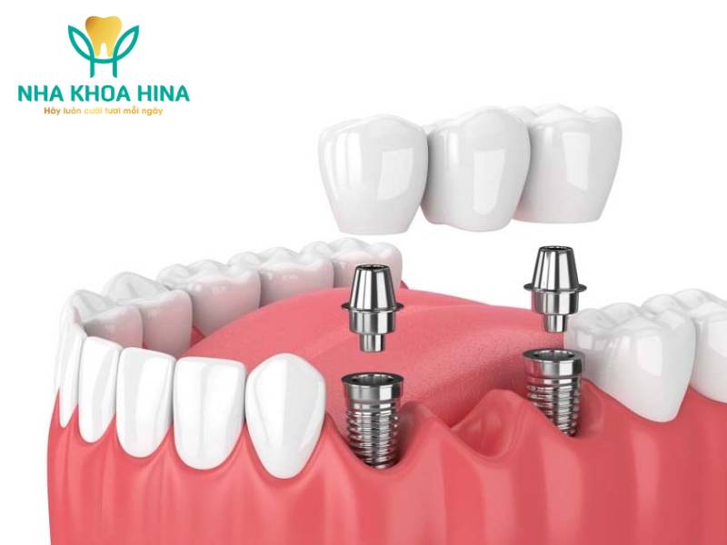  Trồng răng implant hãng nào tốt nhất?