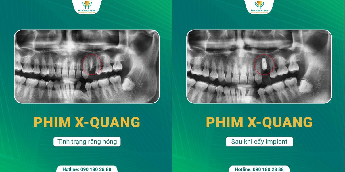 Cấy Ghép Implant
