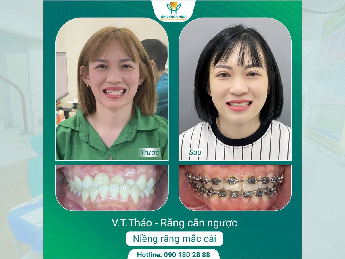 Niềng Răng Cắn Ngược – Không Chỉ Để Đẹp, Mà Để Bảo Vệ Khớp Cắn
