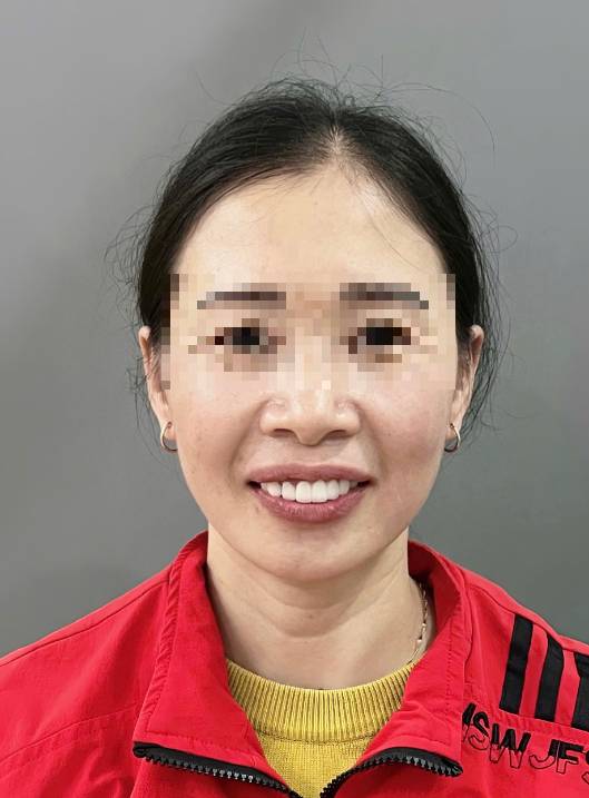 Răng Sứ Toàn Hàm – Giải Pháp Hoàn Hảo Cho Nụ Cười Toả Sáng