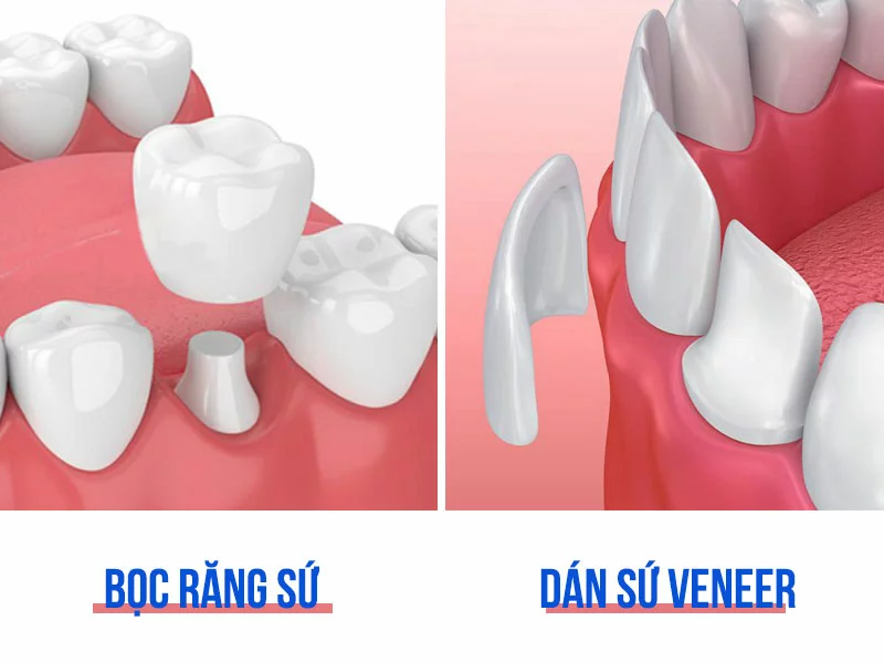 Dán sứ Veneer: Giải pháp hoàn hảo cho hàm răng trắng đều