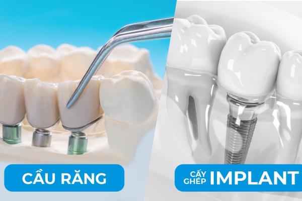 Trồng răng bằng implant hay cầu răng Hải phòng