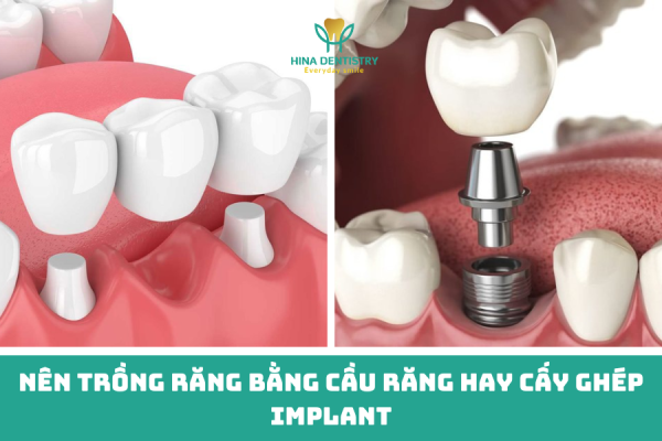 Nên trồng răng bằng cầu răng hay cấy ghép Implant