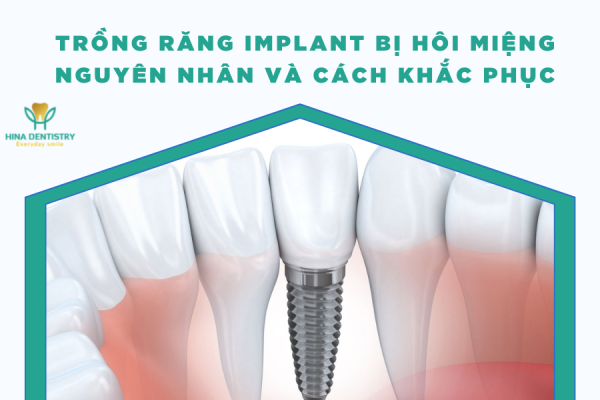 Trồng răng Implant bị hôi miệng - Nguyên nhân và cách khắc phục