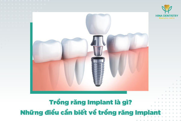 Trồng răng Implant là gì? Những điều cần biết về trồng răng Implant