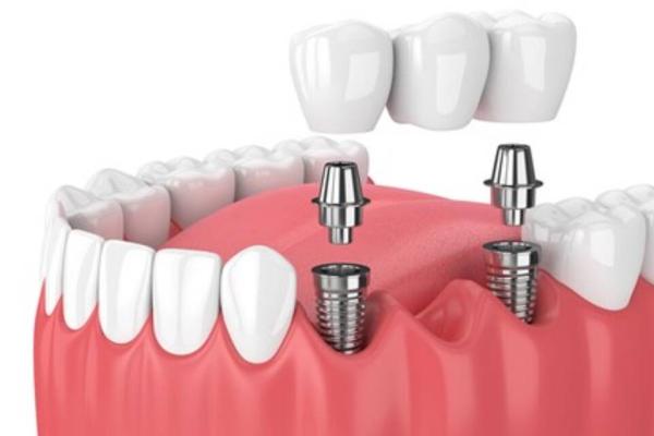 Lợi ích của trồng răng giả Implant so với các phương pháp khác