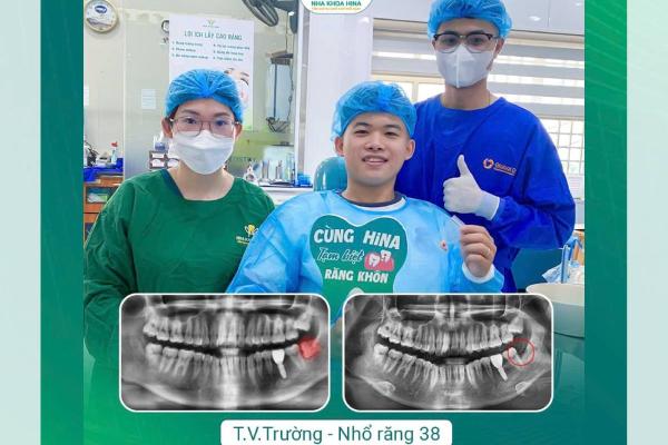 Nhổ răng khôn số 38