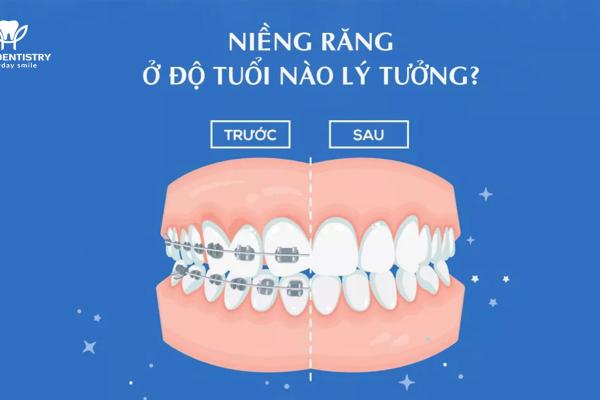 Độ tuổi lý tưởng để niềng răng