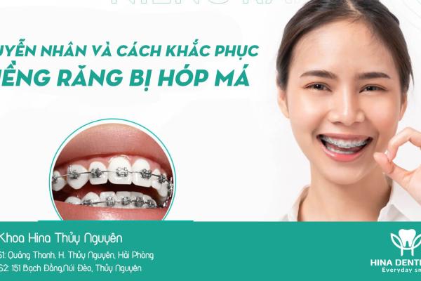 Nguyên nhân và cách khắc phục tình trạng niềng răng bị hóp má