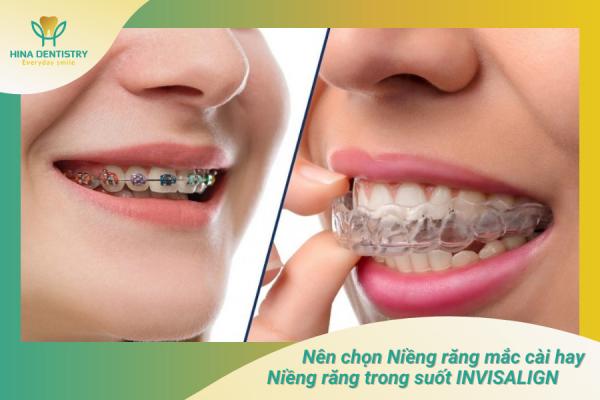 Nên chọn niềng răng mắc cài hay niềng răng trong suốt INVISALIGN