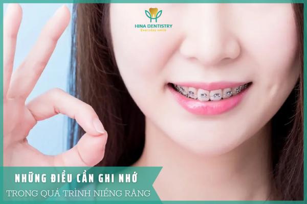 Những điều cần ghi nhớ trong quá trình niềng răng