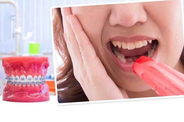 8 Cách giảm đau khi niềng răng đơn giản và hiệu quả nhất