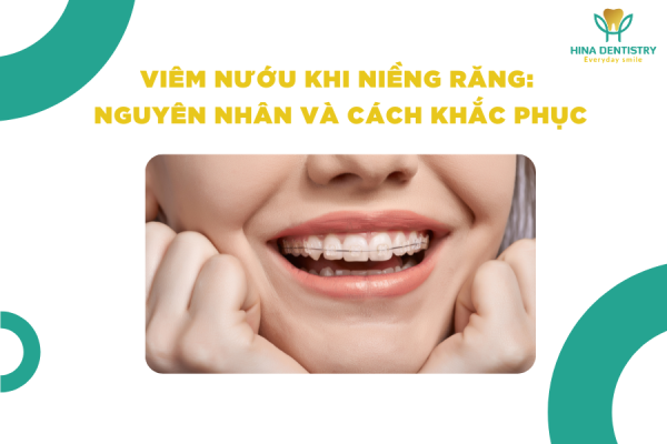 Viêm nướu khi niềng răng: Nguyên nhân và cách khắc phục