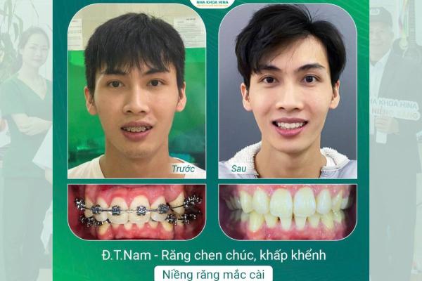 Niềng Răng – Giải Pháp Hoàn Hảo Cho Nụ Cười Tự Tin Và Sức Khỏe Răng Miệng