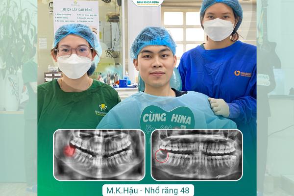 Chia Tay Răng Khôn – Bảo Vệ Răng Số 7 Tránh Nguy Cơ Hư Hại