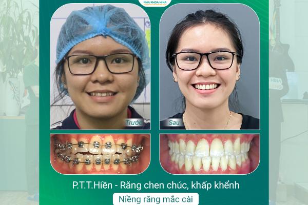 Niềng Răng – Tạm Biệt Tự Ti, Tự Tin Nụ Cười Rạng Rỡ