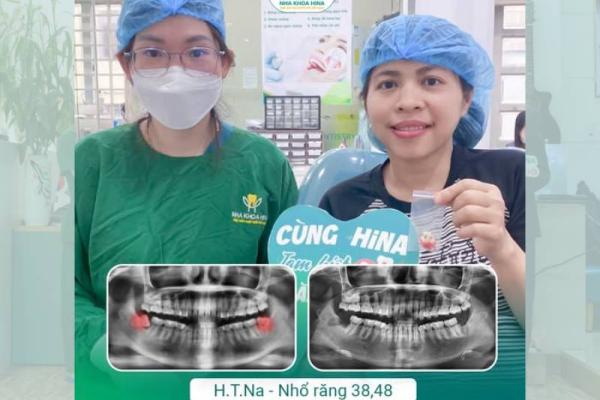 Đau Răng Khôn Bao Lâu Thì Hết? Có Cần Nhổ Không?