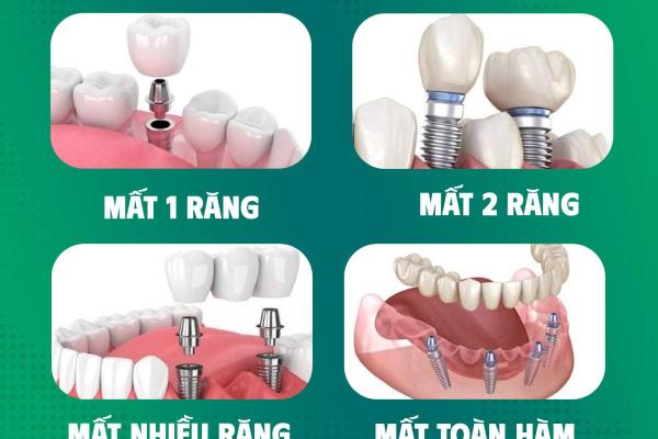 Các trường hợp cần cấy ghép Implant