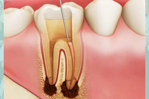 Viêm tuỷ răng - Biến chứng từ răng sâu không điều trị