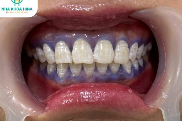 Tẩy Trắng Răng – Giải Pháp Cho Nụ Cười Tỏa Sáng