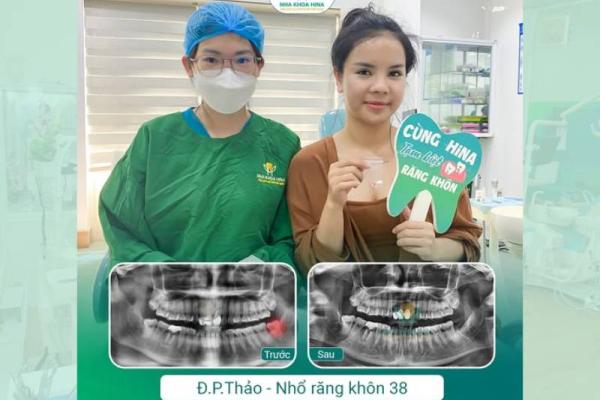 Mất ngủ vì đau răng khôn? Giải pháp hiệu quả tại Nha khoa Hina