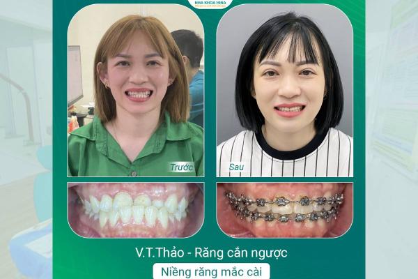 Niềng Răng Cắn Ngược – Không Chỉ Để Đẹp, Mà Để Bảo Vệ Khớp Cắn