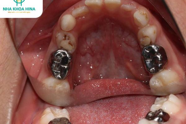 Chụp Thép – “Áo Giáp Bảo Vệ” Răng Sữa Cho Trẻ